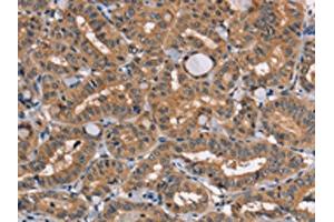 The image on the left is immunohistochemistry of paraffin-embedded Human thyroid cancer tissue using ABIN7131459(TRAFD1 Antibody) at dilution 1/20, on the right is treated with fusion protein.