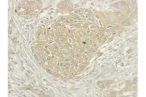 ABIN6265637 and ABIN6277084 at 1/100 staining human tongue carcinoma by IHC-P.