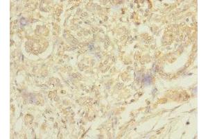 Immunohistochemistry of paraffin-embedded human pancreatic cancer using ABIN7159422 at dilution of 1:100 (MESP1 anticorps  (AA 149-268))