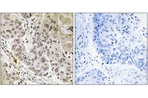 Immunohistochemistry analysis of paraffin-embedded human lung carcinoma tissue, using STK36 Antibody. (STK36 anticorps  (AA 387-436))