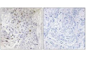 Immunohistochemistry analysis of paraffin-embedded human breast carcinoma tissue, using MAFF antibody. (MafF anticorps  (Internal Region))