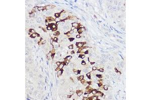 Immunohistochemistry of paraffin-embedded human breast cancer using PIGR Rabbit pAb (ABIN6128562, ABIN6145618, ABIN6145620 and ABIN6221728) at dilution of 1:100 (40x lens).