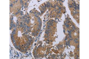 Immunohistochemistry of Human colon cancer using PRKD3 Polyclonal Antibody at dilution of 1:50 (PRKD3 anticorps)