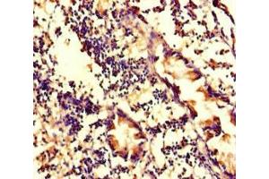 Immunohistochemistry of paraffin-embedded human appendix tissue using ABIN7175714 at dilution of 1:100 (WDFY4 anticorps  (AA 1-322))