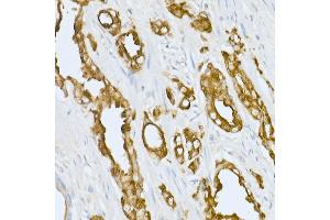 Immunohistochemistry of paraffin-embedded human prostate cancer using Prostatic Acid Phosphatase (ACPP) Rabbit pAb (ABIN3022671, ABIN3022672, ABIN3022673 and ABIN6219082) at dilution of 1:50 (40x lens). (ACPP anticorps  (AA 40-300))