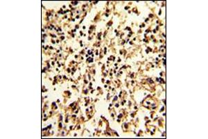 Formalin-Fixed, Paraffin-Embedded Human lymph with SERPINA9 Antibody (Center), which was peroxidase-conjugated to the secondary antibody, followed by DAB staining.