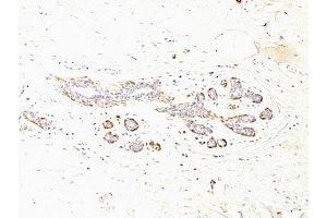 Formalin-fixed, paraffin-embedded human breast carcinoma stained with SMMHC antibody (MYH11/923 + SMMS-1). (MYH11 anticorps)