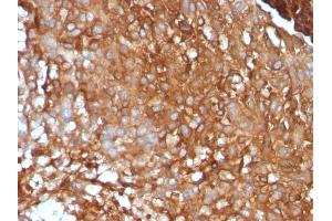 Formalin-fixed, paraffin-embedded human Melanoma stained with Beta-2-Microglobulin Mouse Monoclonal Antibody (B2M/961).