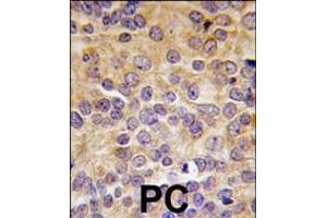 Formalin-fixed and paraffin-embedded human prostata carcinoma tissue reacted with PRMT3 antibody (N-term), which was peroxidase-conjugated to the secondary antibody, followed by DAB staining. (PRMT3 anticorps  (N-Term))