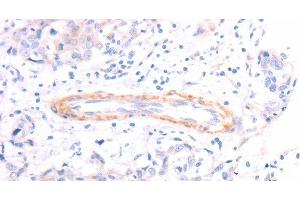 Immunohistochemistry of paraffin-embedded Human breast cancer using TPM1 Polyclonal Antibody at dilution of 1:40 (Tropomyosin anticorps)