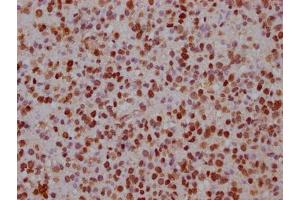 IHC image of ABIN7152619 diluted at 1:100 and staining in paraffin-embedded human glioma cancer performed on a Leica BondTM system.