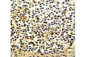 IHC analysis of FFPE human kidney carcinoma with DCXR antibody