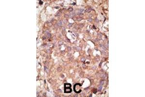 Formalin-fixed and paraffin-embedded human cancer tissue reacted with the primary antibody, which was peroxidase-conjugated to the secondary antibody, followed by DAB staining.