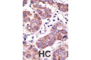 Formalin-fixed and paraffin-embedded human hepatocellular carcinoma tissue reacted with USP3 polyclonal antibody  , which was peroxidase-conjugated to the secondary antibody, followed by DAB staining. (USP3 anticorps  (N-Term))