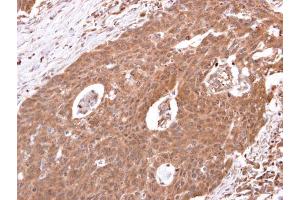 IHC-P Image beta 2 Adrenergic Receptor antibody [C2C3], C-term detects beta 2 Adrenergic Receptor protein at cytosol on human colon carcinoma by immunohistochemical analysis. (beta 2 Adrenergic Receptor anticorps  (C-Term))