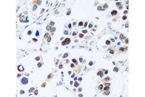 Immunohistochemistry of paraffin-embedded Human lung cancer using BRIX1 Polyclonal Antibody at dilution of 1:100 (40x lens). (BRIX1 anticorps)