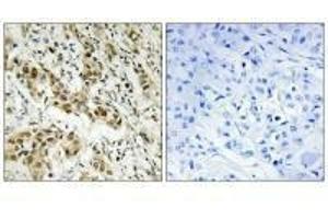 Immunohistochemistry analysis of paraffin-embedded human breast carcinoma tissue using CtBP1 (Ab-422) antibody. (CTBP1 anticorps  (Ser422))