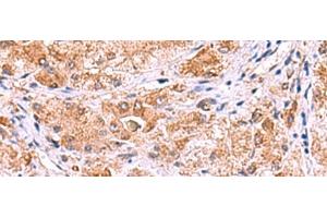 Immunohistochemistry of paraffin-embedded Human liver cancer tissue using UXS1 Polyclonal Antibody at dilution of 1:60(x200) (UXS1 anticorps)