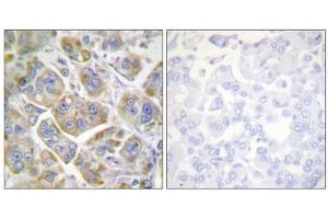 Immunohistochemistry analysis of paraffin-embedded human breast carcinoma tissue using ITGB4 (epitope around residue 1510) antibody.