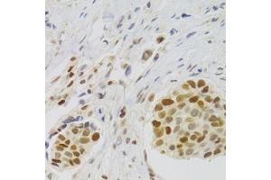 Immunohistochemistry of paraffin-embedded human breast cancer using NASP Antibody.