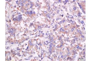 Formalin-fixed and paraffin embedded human lung carcinoma labeled with Anti-CD55/DAF Polyclonal Antibody, Unconjugated  at 1:200 followed by conjugation to the secondary antibody and DAB staining. (CD55 anticorps  (AA 301-381))