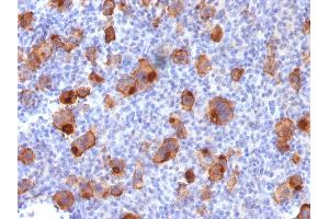Formalin-fixed, paraffin-embedded human Hodgkin's Lymphoma stained with CD30 Rabbit Recombinant Monoclonal Antibody (Ki-1/1747R). (Recombinant TNFRSF8 anticorps)