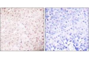 Immunohistochemistry analysis of paraffin-embedded human breast carcinoma tissue, using p300/CBP Antibody. (KAT2B anticorps  (AA 783-832))
