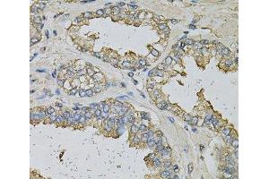 Immunohistochemistry of paraffin-embedded Human prostate using ALDH3A1 Polyclonal Antibody at dilution of 1:100 (40x lens). (ALDH3A1 anticorps)