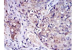 Immunohistochemical analysis of paraffin-embedded human lung cancer tissues using IRAK4 mouse mAb with DAB staining.