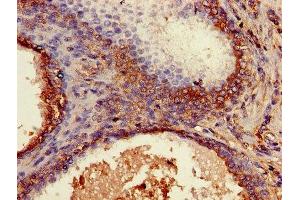 Immunohistochemistry of paraffin-embedded human prostate cancer using ABIN7145421 at dilution of 1:100