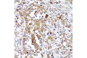 Immunohistochemistry of paraffin-embedded human uterine cancer using ACTR2 antibody. (ACTR2 anticorps  (AA 1-160))