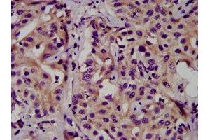 IHC image of ABIN7146788 diluted at 1:500 and staining in paraffin-embedded human liver cancer performed on a Leica BondTM system. (CEACAM16 anticorps  (AA 323-414))