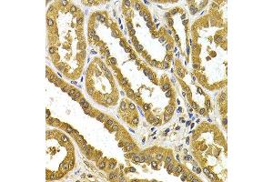 Immunohistochemistry of paraffin-embedded human kidney cancer using UGT1A4 antibody at dilution of 1:200 (400x lens). (UGT1A4 anticorps)