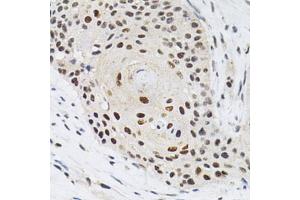 Immunohistochemistry of paraffin-embedded human esophageal cancer using KPNA4 Antibody (ABIN5971058) at dilution of 1/200 (40x lens). (KPNA4 anticorps)