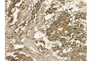 LIMS2 Mouse Monoclonal Antibody at 1/100 staining human colorectal cancer by IHC-P. (LIMS2 anticorps)