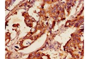 Immunohistochemistry of paraffin-embedded human gastric cancer using ABIN7154080 at dilution of 1:100 (Glutathione Reductase anticorps  (AA 47-219))