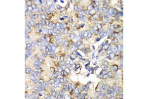 Immunohistochemistry of paraffin-embedded human prostate cancer using TFAM antibody (ABIN6290990) at dilution of 1:100 (40x lens). (TFAM anticorps)
