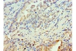 Immunohistochemistry of paraffin-embedded human lung cancer using ABIN7162505 at dilution of 1:100 (PAX6 anticorps  (AA 1-300))