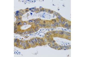 Immunohistochemistry of paraffin-embedded Human colorectal cancer using MBL2 antibody (ABIN6132334, ABIN6143597, ABIN6143600 and ABIN6221519) at dilution of 1:100 (40x lens).