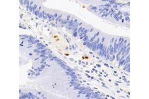 Immunohistochemistry analysis of paraffin-embedded human colon cancer using S100A12 (ABIN7075493) at dilution of 1: 4000 (S100A12 anticorps)