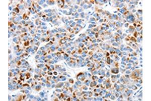 The image on the left is immunohistochemistry of paraffin-embedded Human liver cancer tissue using ABIN7128970(CLIP1 Antibody) at dilution 1/30, on the right is treated with fusion protein. (CLIP1 anticorps)