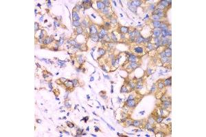 Immunohistochemistry of paraffin-embedded human liver cancer using RPS3A Antibody. (RPS3A anticorps  (AA 1-264))