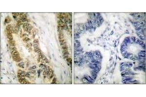 Immunohistochemistry analysis of paraffin-embedded human colon carcinoma tissue, using SP1 (Ab-739) Antibody.