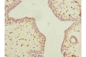 Immunohistochemistry of paraffin-embedded human breast cancer using ABIN7160535 at dilution of 1:100 (MYLK3 anticorps  (AA 1-240))