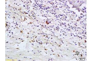Formalin-fixed and paraffin embedded human breast carcinoma labeled with Anti- TLR5 Polyclonal Antibody, Unconjugated (ABIN673239) at 1:200 followed by conjugation to the secondary antibody and DAB staining (TLR5 anticorps  (AA 701-810))