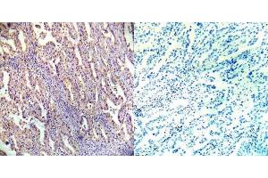 Immunohistochemical analysis of paraffin- embedded human lung carcinoma tissue using AMPKbeta1 (Ab-182) antibody (E022004). (PRKAB1 anticorps)