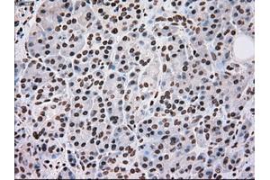 Immunohistochemical staining of paraffin-embedded Adenocarcinoma of breast tissue using anti-SCYL3 mouse monoclonal antibody. (SCYL3 anticorps)