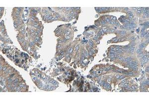 ABIN6277239 at 1/100 staining Human cervical cancer tissue by IHC-P. (SERPINH1 anticorps  (Internal Region))