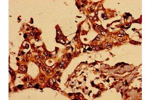 Immunohistochemistry of paraffin-embedded human pancreatic cancer using ABIN7153987 at dilution of 1:100