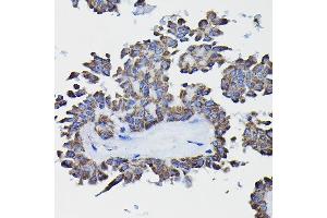 Immunohistochemistry of paraffin-embedded human thyroid cancer using GSTK1 Rabbit pAb (ABIN1680136, ABIN3019398, ABIN3019399 and ABIN6220875) at dilution of 1:25 (40x lens). (GSTK1 anticorps  (AA 1-226))